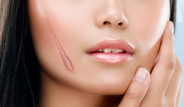 Sẹo lồi lâu năm – làm sao để hết