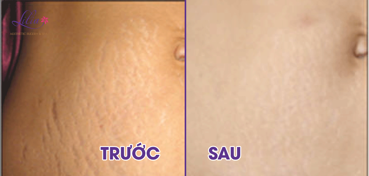 Điều trị sẹo lồi công nghệ Laser CO2 Fractional