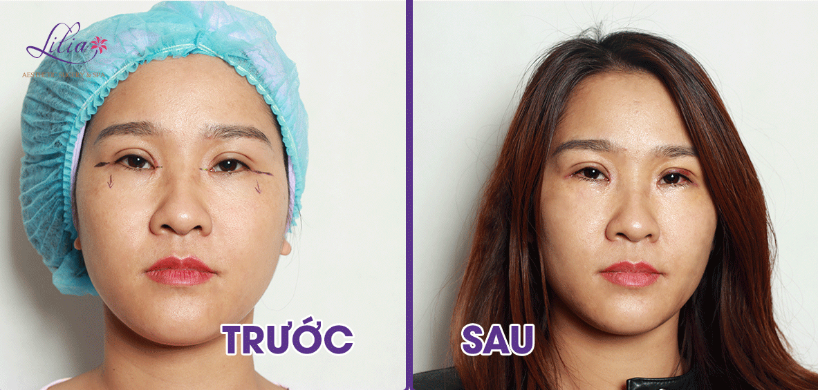 Cắt da thừa mí mắt dưới