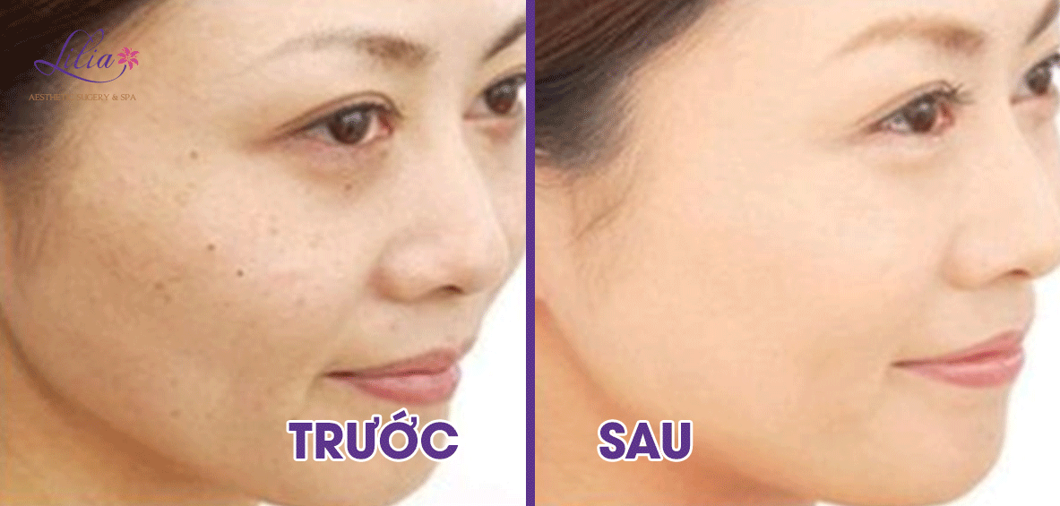 Trị mụn đầu đen