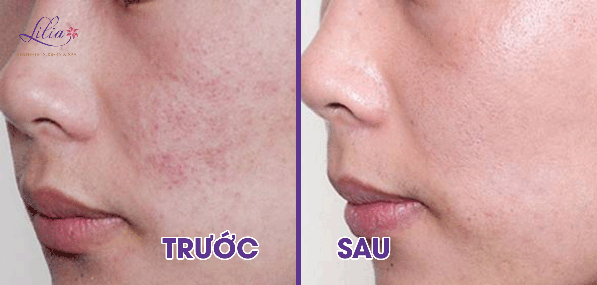 Trị mụn bọc