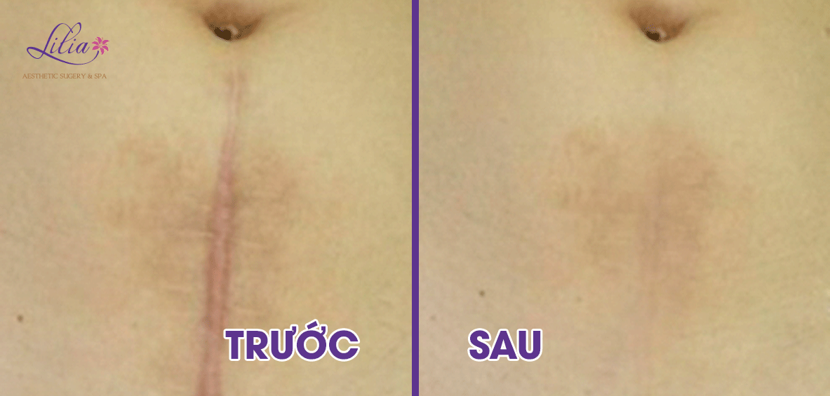 Điều trị sẹo lồi công nghệ Laser CO2 Fractional