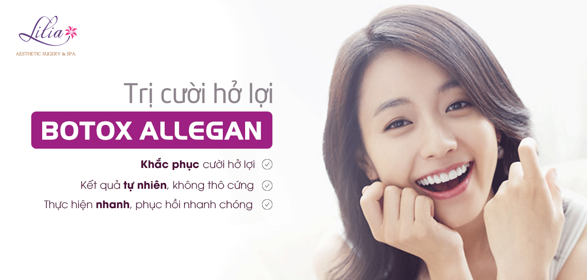 Trị cười hở lợi bằng botox