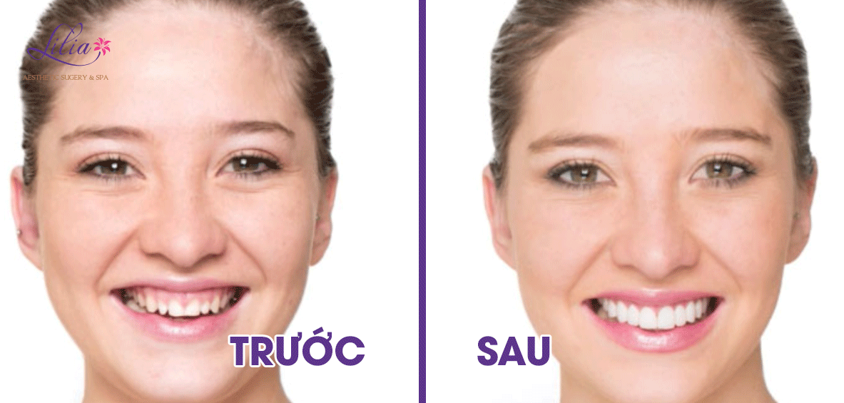 Trị cười hở lợi bằng botox