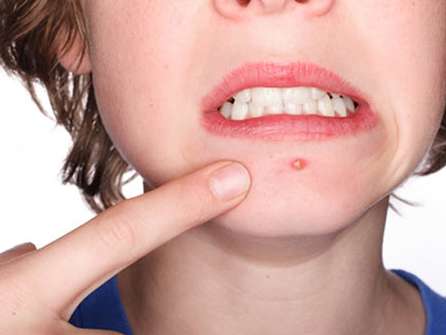 Trị mụn bọc ở đâu tốt nhất hiện nay?