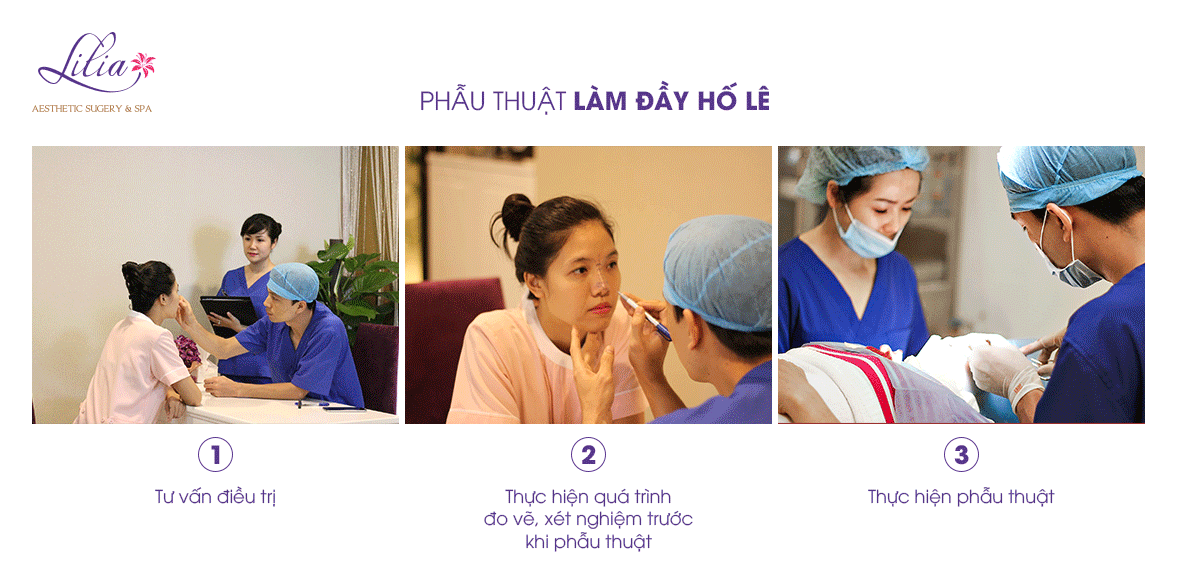 Phẫu thuật hố lê